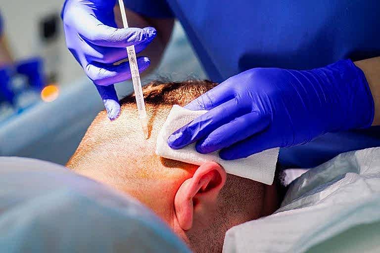 Hizli-Sac-Ekimi-Kimler-icin-Uygundur