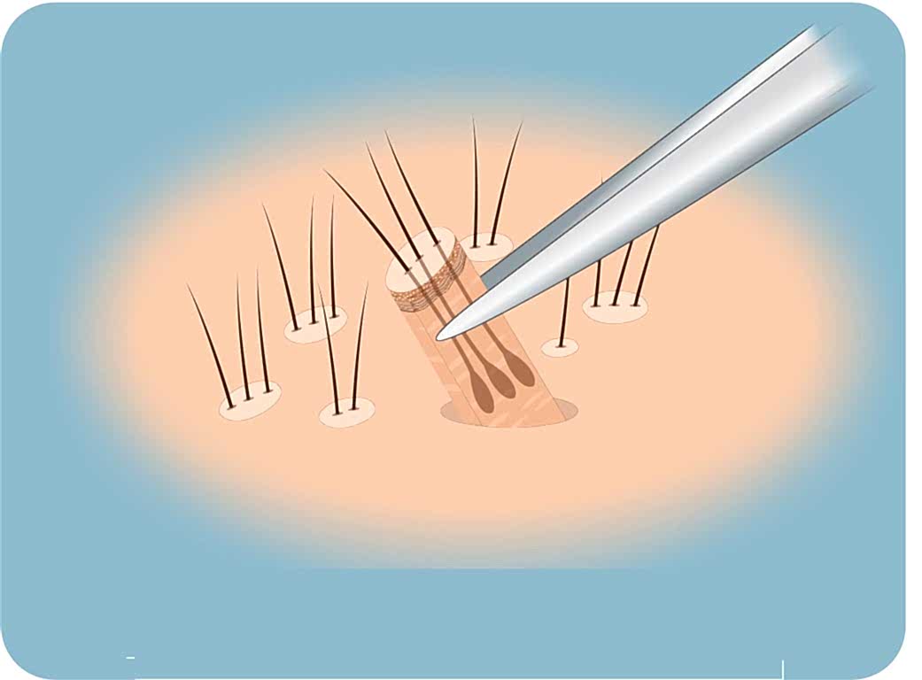 Optivuzor-gozluk-sac-ekimi