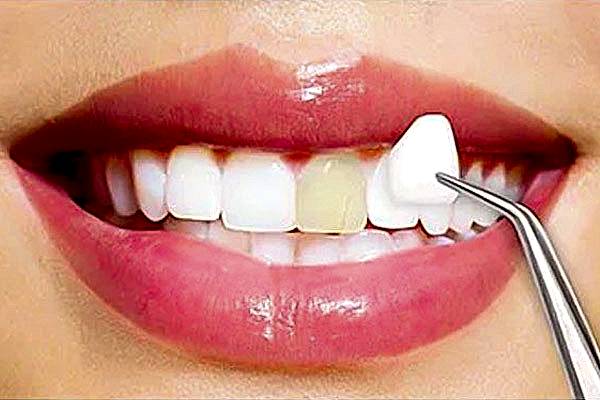 Diş-Kaplama-Çeşitleri-Nelerdir